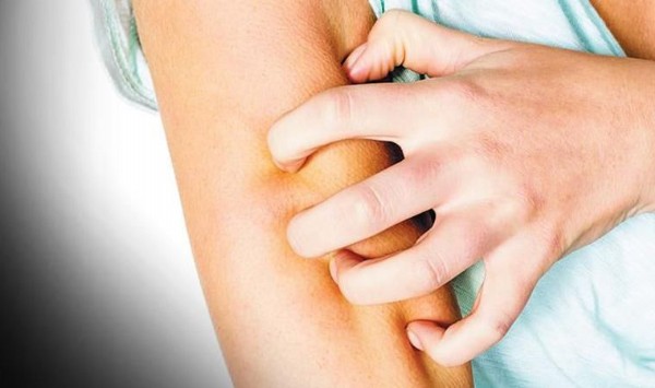 Uyuz Nasıl Geçer? Uyuz Belirtileri